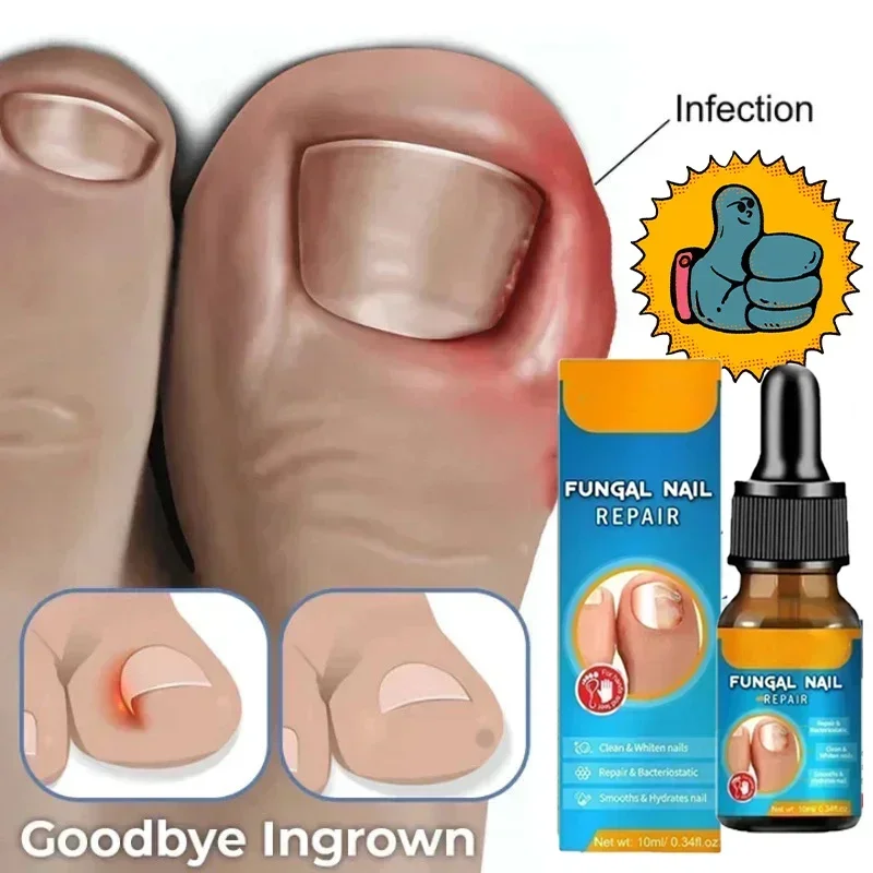 

Nail Fungus Treatment Serum Foot Repair Liquid Toe Nails Fungal Removal Gel Anti Infection Paronychia Onychomycosis