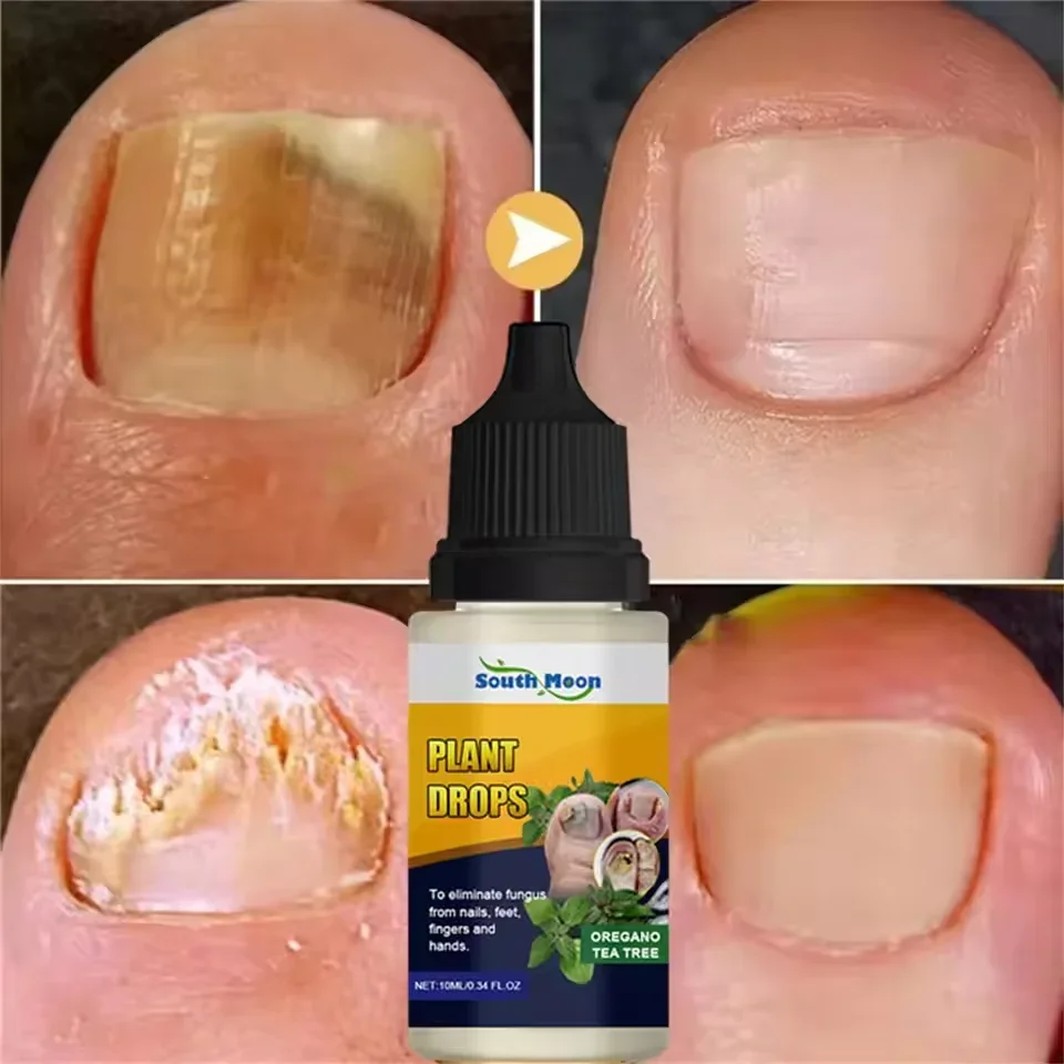 7 日間爪真菌治療液体血清抗感染爪真菌症爪周囲炎ハンドケア爪足真菌除去ジェル 10 ミリリットル