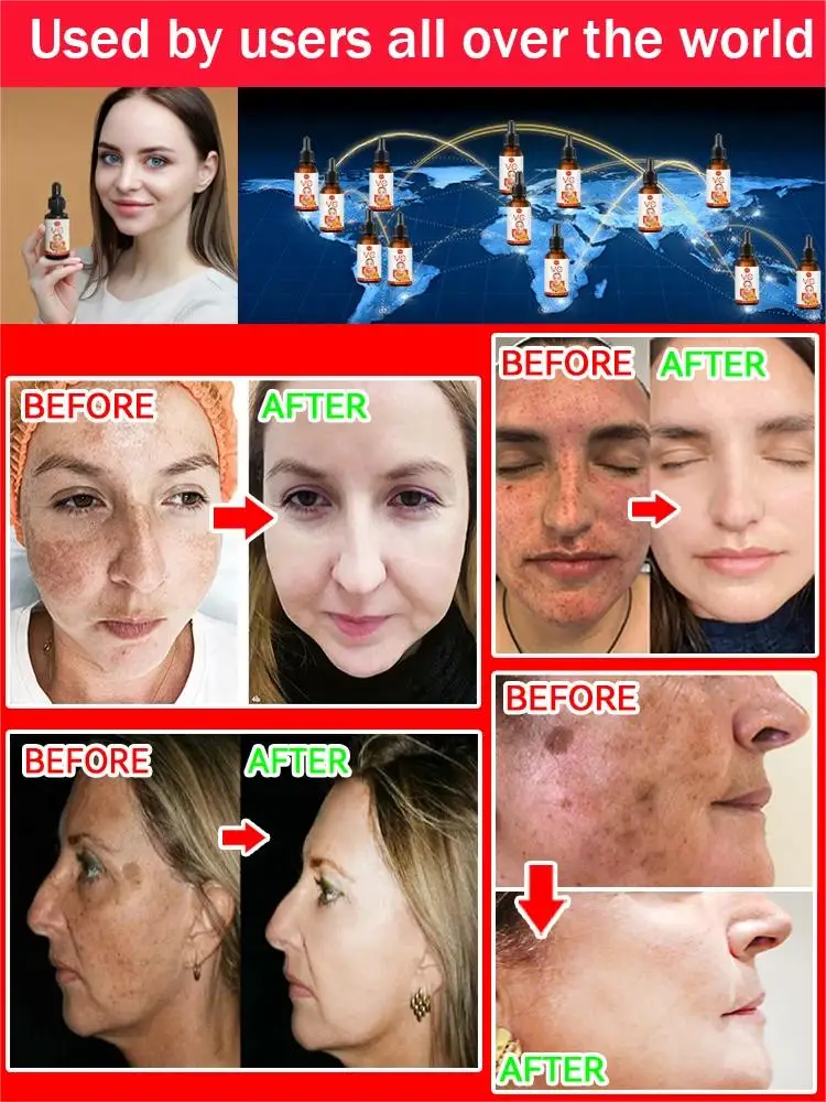 Eliminador de manchas oscuras, pecas, Melasma, cara