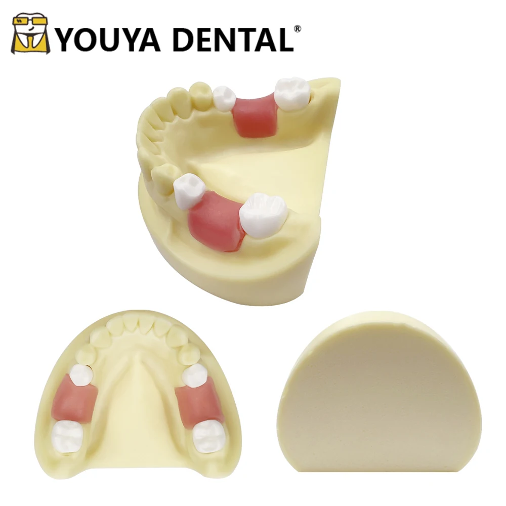 Dental Teeth Implant Practice Model Mandibular Missing Teeth Implant Teaching Model For Dentist Technician Studying Training