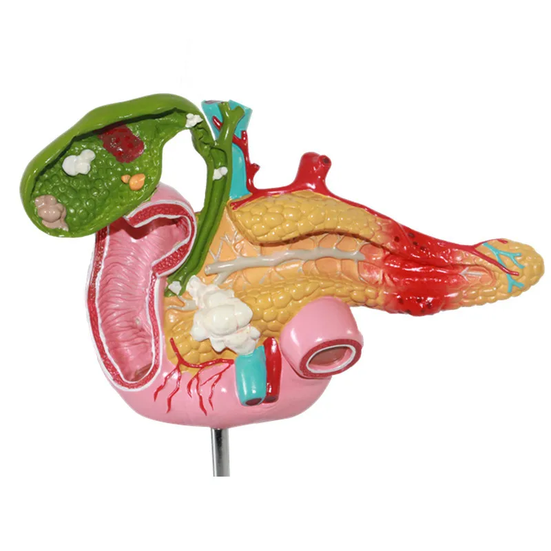 Pathological model of pancreas, duodenal gallbladder, hepatobiliary model of gallstone surgery system