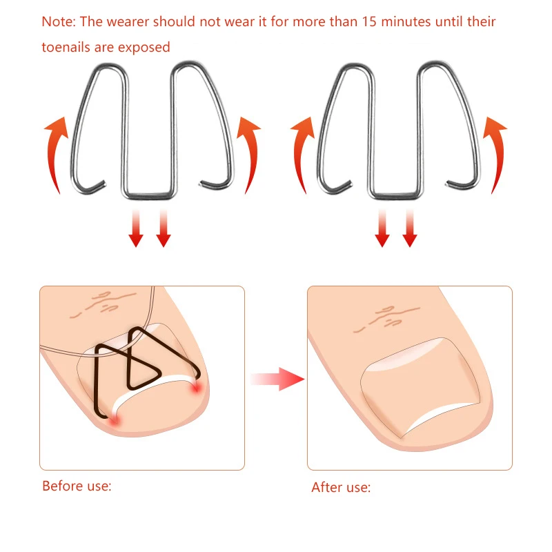 Corrector de uñas encarnadas para el cuidado de los pies, Clips de alisado de alambre, herramientas de corrección de las uñas de los pies, gancho fijador para las uñas de los pies