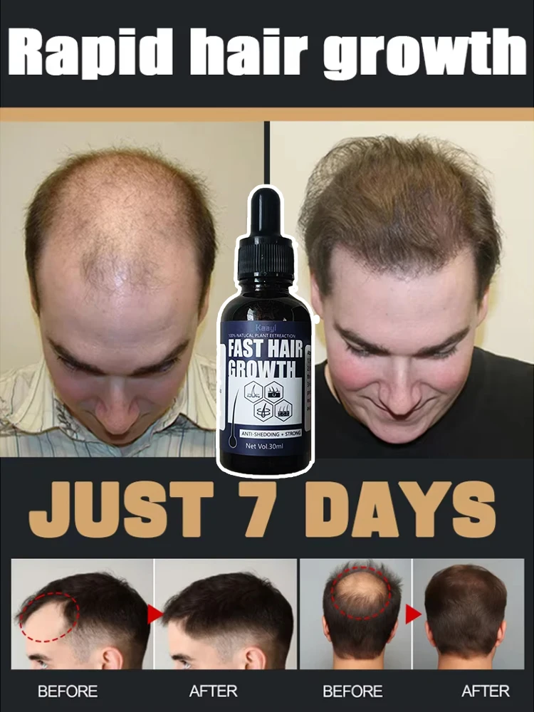 

98% of buyers buy again, have more and more hair, say goodbye to baldness, thick hair,Hot selling product