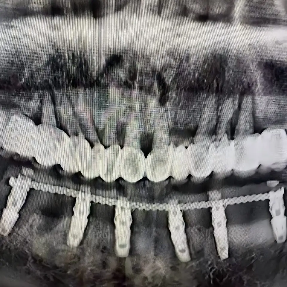 Dental Medical Titanium Wire 100mm 3-Strand Twist Implant Connecting Strengthening Bar Provisional Overdenture Material