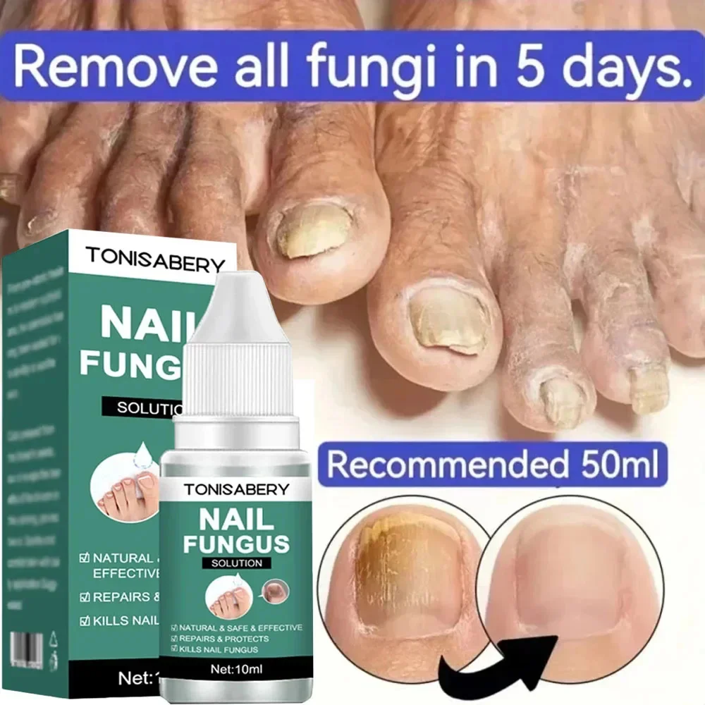 เชื้อราเล็บ Treatment Serum Foot Repair Liquid Toe เล็บ Fungal Removal GEL Anti Infection Paronychia Onychomycosis ครีม 10ml