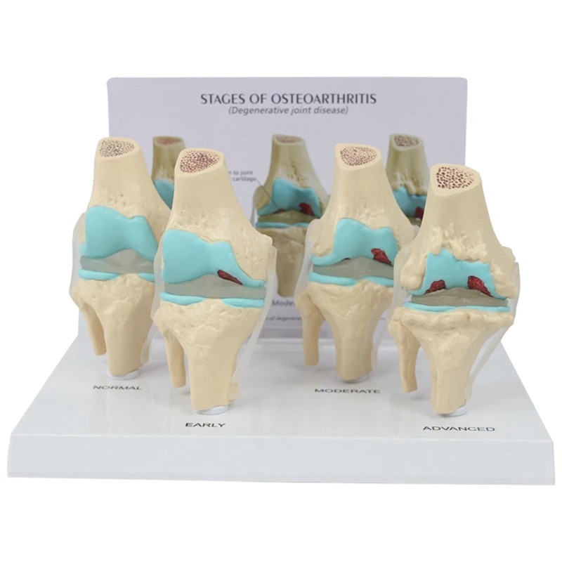 Knee Kit Osteoarthritis Anatomy Model With Educational Key Card 4 Stage Knee Model Orthopedic Teaching Aids