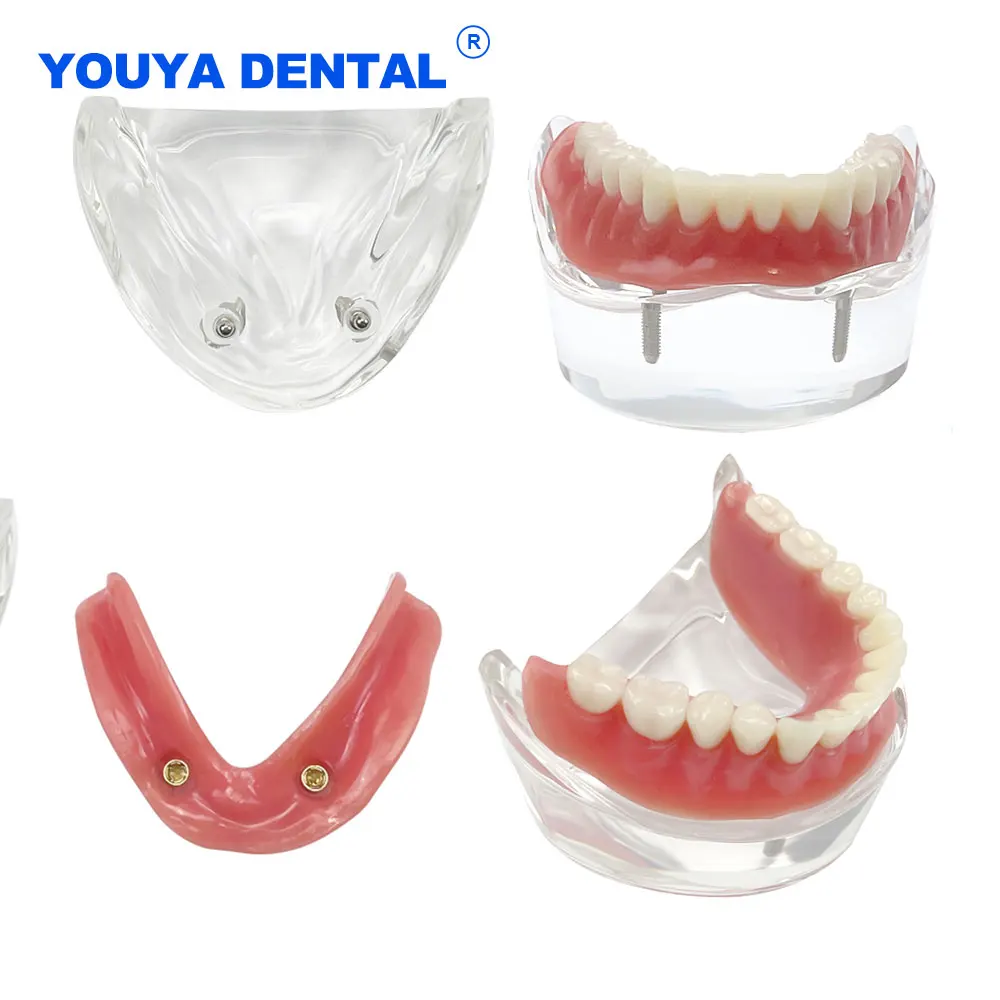 Lower Dental Teeth Model Overdenture Superior with 2 Implant Restoration Interior Mandibular Teach Model for Teaching Study