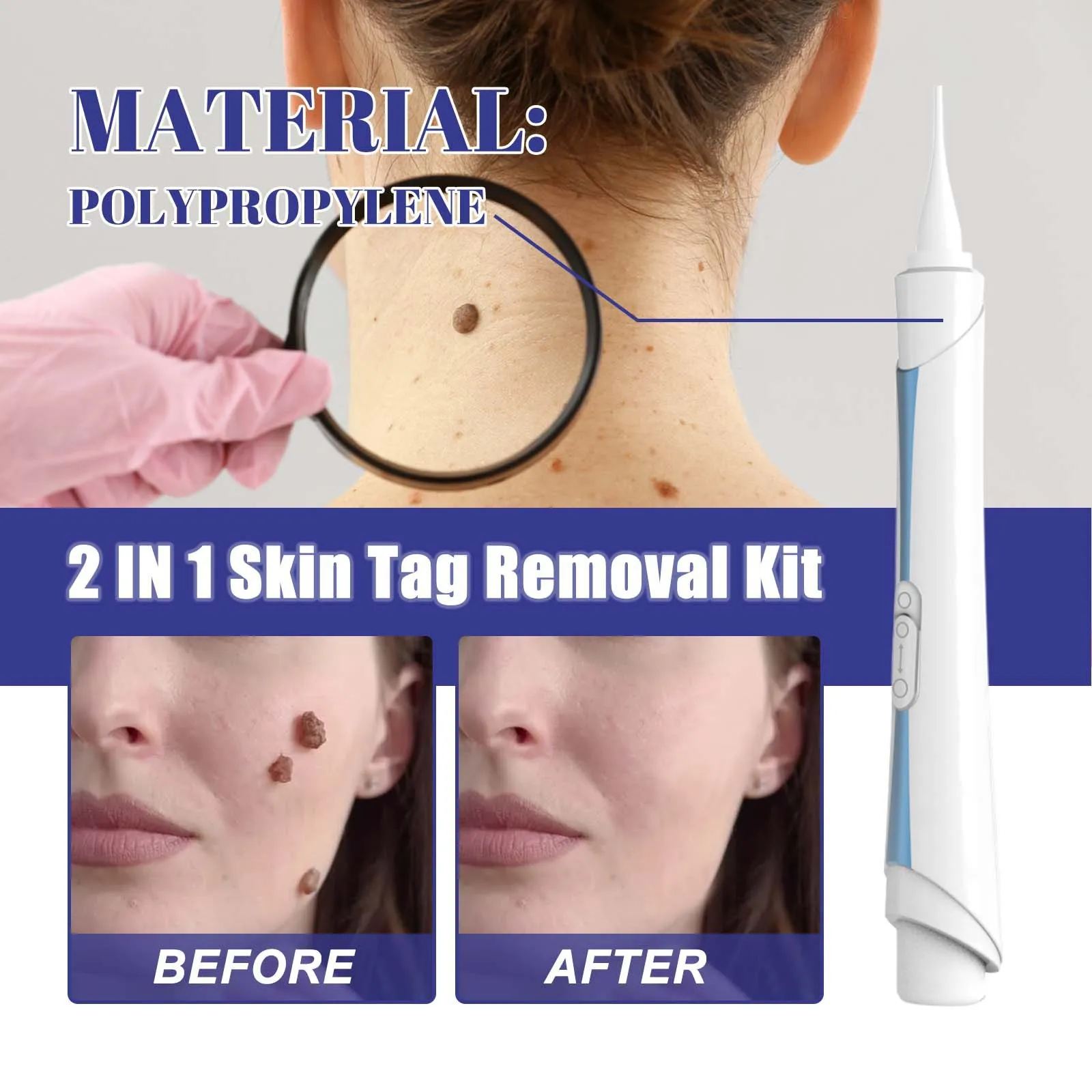 2 in1 무통증 피부 태그 점 제거 키트 클리닝 도구 얼굴 피부 관리 바디 점 치료 제거기 뷰티 헬스