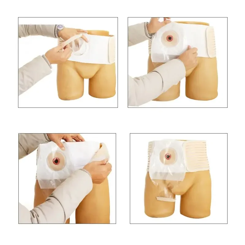 

S/M/L/XXLOstomy Abdominal Belt Brace Waist Support Wear on The Abdominal Stoma To Fix Bag Prevent Parastomal Hernia Back Brace