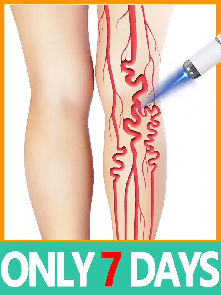 أدوات جديدة لمنع الدوالي لعام 2020. قلم الضوء الأزرق. حل ساق العنكبوت. #1