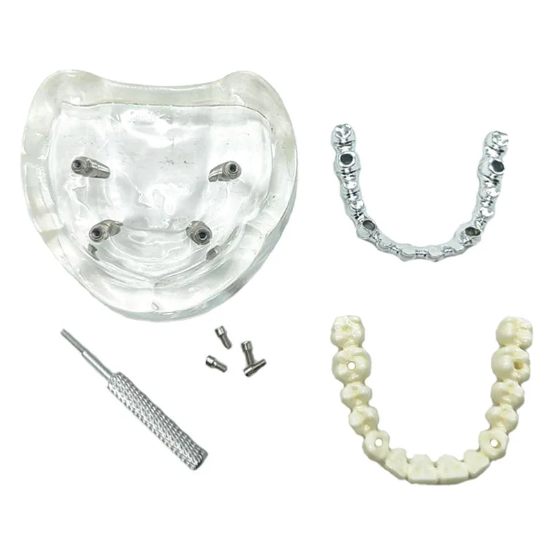 1Pc Dental Implant Model Overdenture Restoration Upper Jaw Removable Teeth Model With 4 Implants for Dentisit Teaching Research