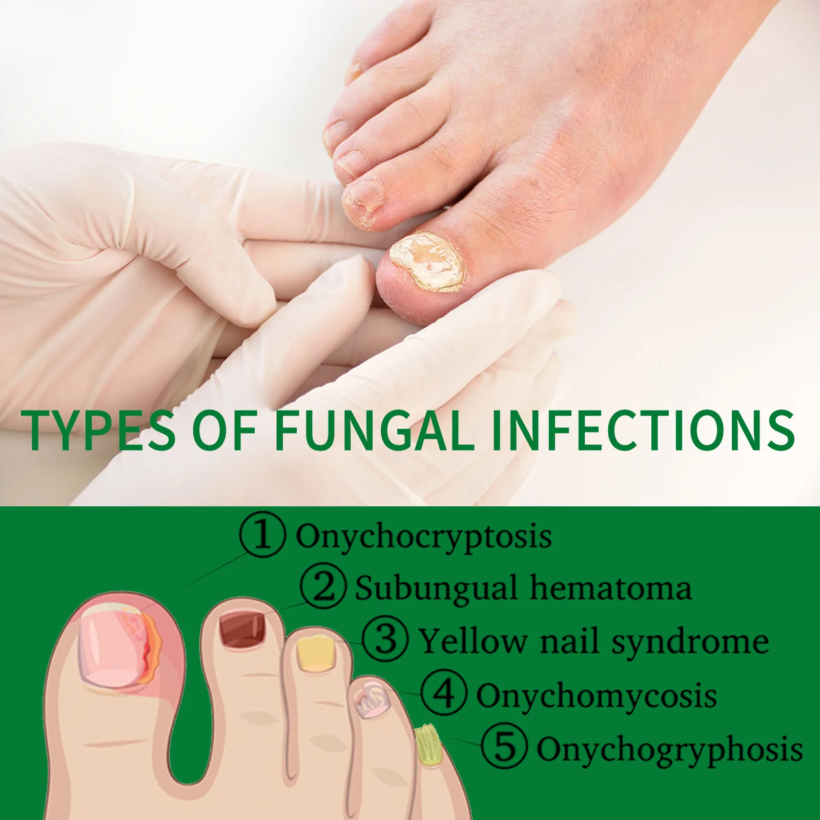 Nail Fungus Treatment Serum Care Hand and Foot Care Removal Repair Gel Anti-infective Onychomycosis Ginger Nail Care Solution