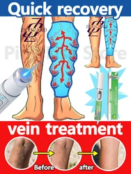 Vein problems