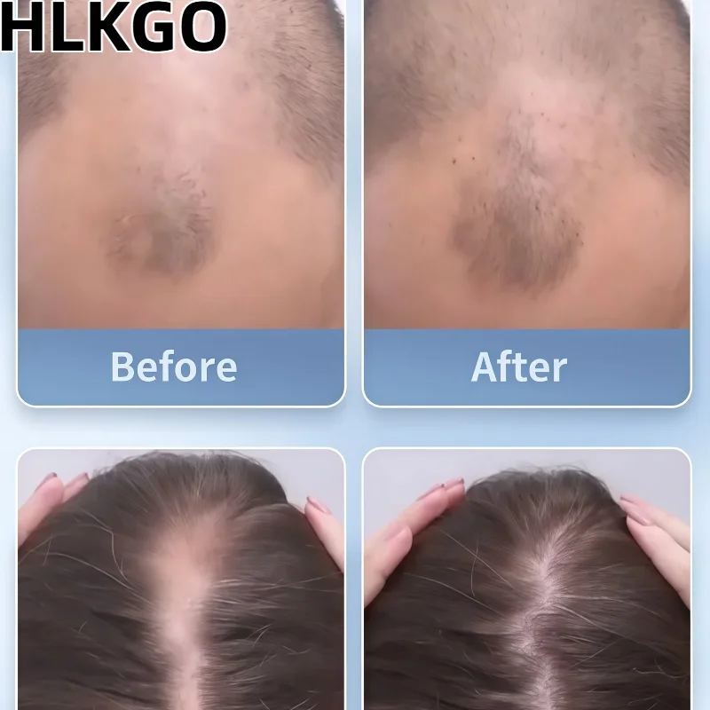 

Red Light Hair Physiotherapy Cap Laser Therapy Device Improves Hair Growth and Density