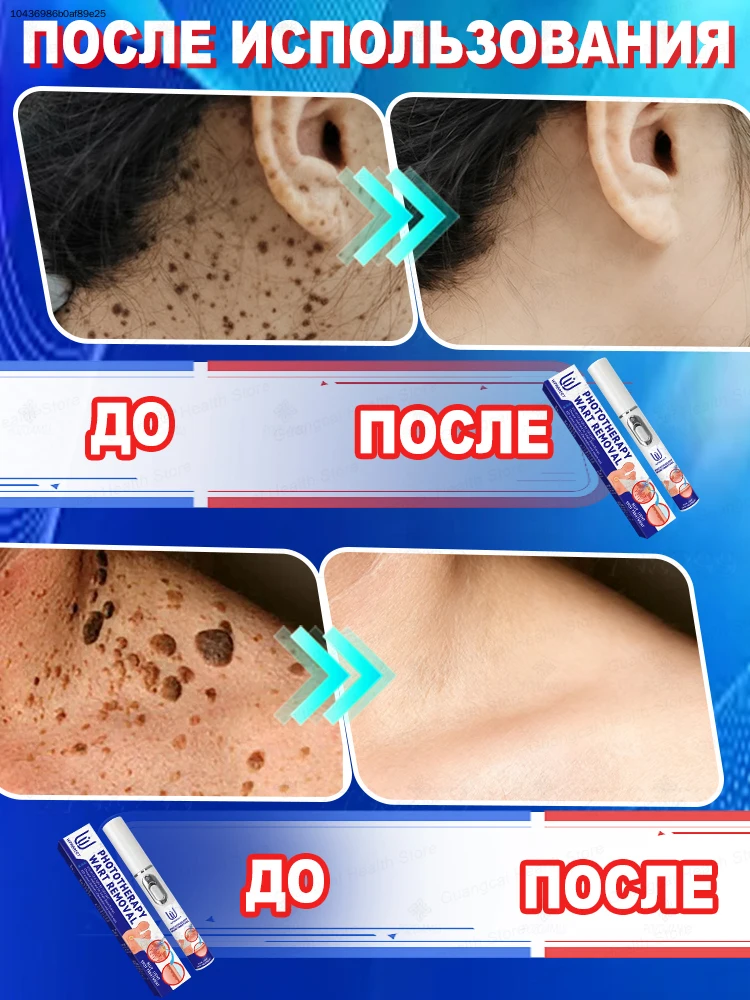 

Достаточно одной процедуры, чтобы избавиться от бородавок.