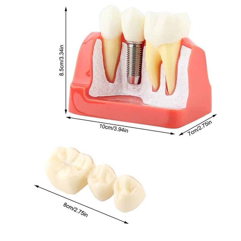 Teeth Demonstration Model Implant Removable Analysis Crown Bridge For -Patient Communication