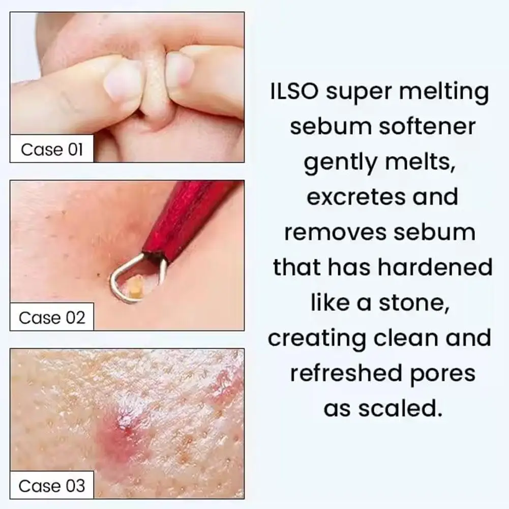 Ilso Blackhead Extractor Toner Multiple Plant Extracts Soothe and Cleanse the Skin Stronger Blackhead Cleansing Facial Care