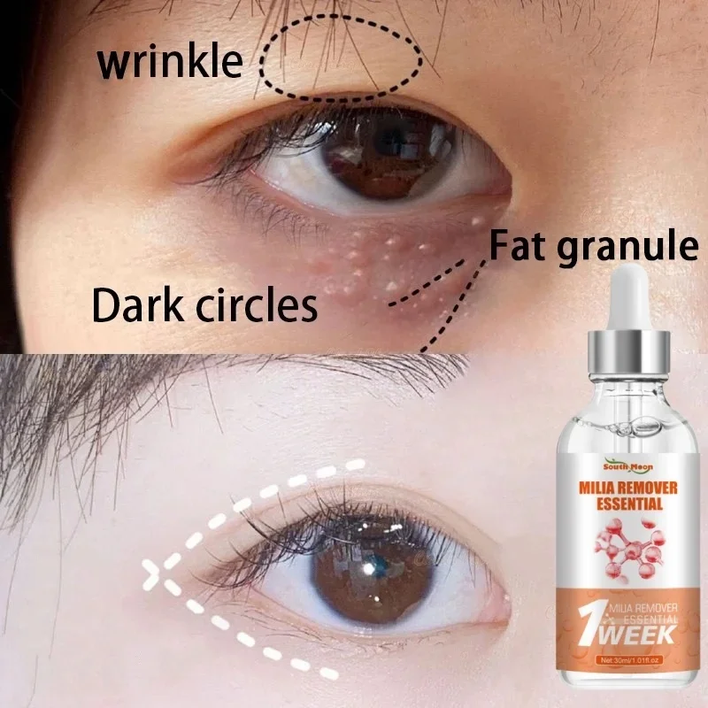 Fat Granules Removal Eye Serum Eye Milia Repair Treatment Products Wrinkle Lifting Moisturizing Anti-Puffiness Korean Skin Care