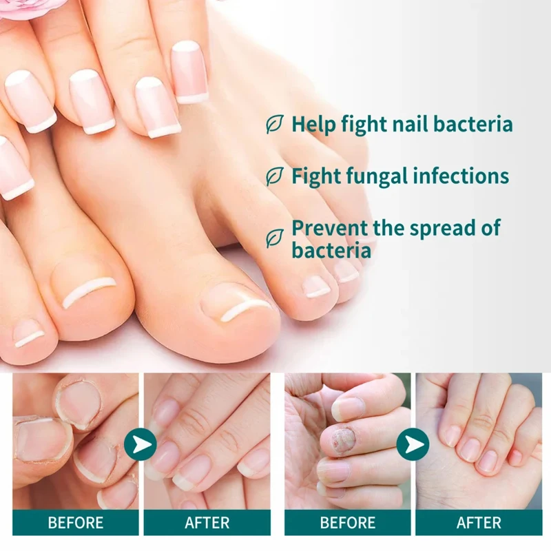 Cura delle unghie Soluzione per il trattamento dei funghi Mani Piedi Anti-Infezione Ispessimento delle unghie Curling Peeling Atrofia Onicomicosi 3ml