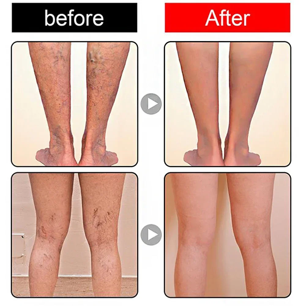 New Potent Formula Ointment For Varicose Veins Effective Varicose Vein Relief To Relieve Vasculitis Phlebitis Spider Pain