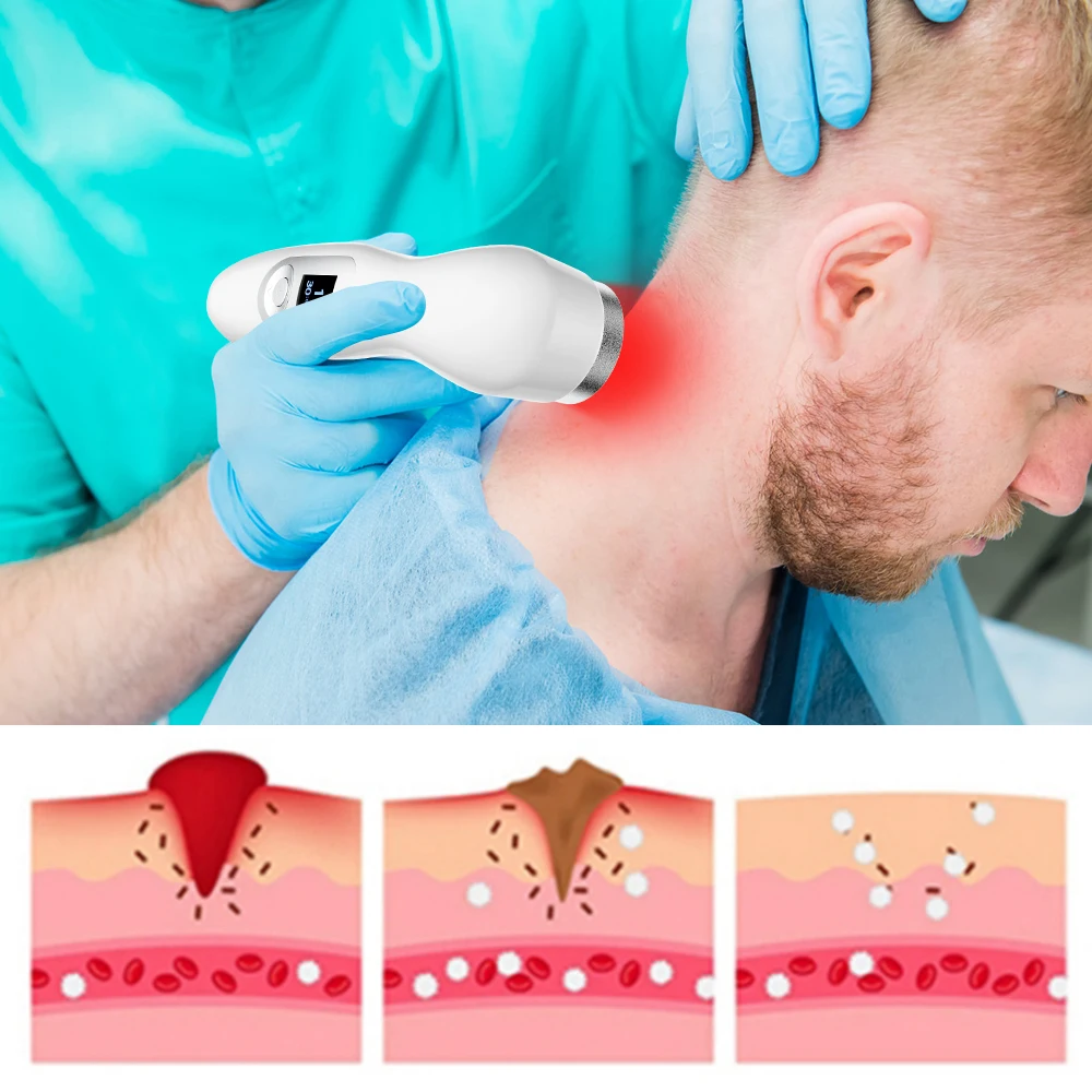 Suyzeko Cold Laser Therapy Device Pulse Mode Red Light Physiotherapy Pain Relief for Knee Joint Muscle Body Home Personal Care