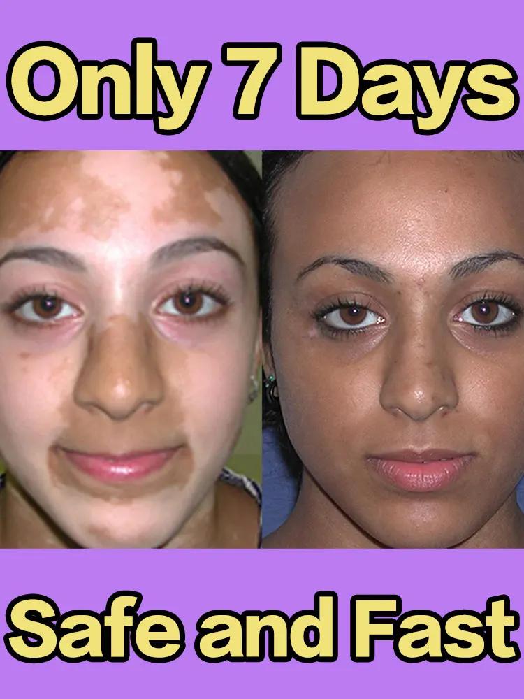 

Vitiligo Ointment Improves Skin Eliminate White Spot