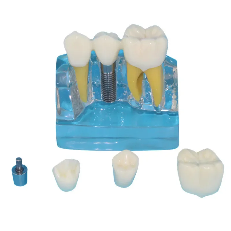 Model Gigi Mulut Manusia, Model Gigi Transparan, Model Implan Gigi
