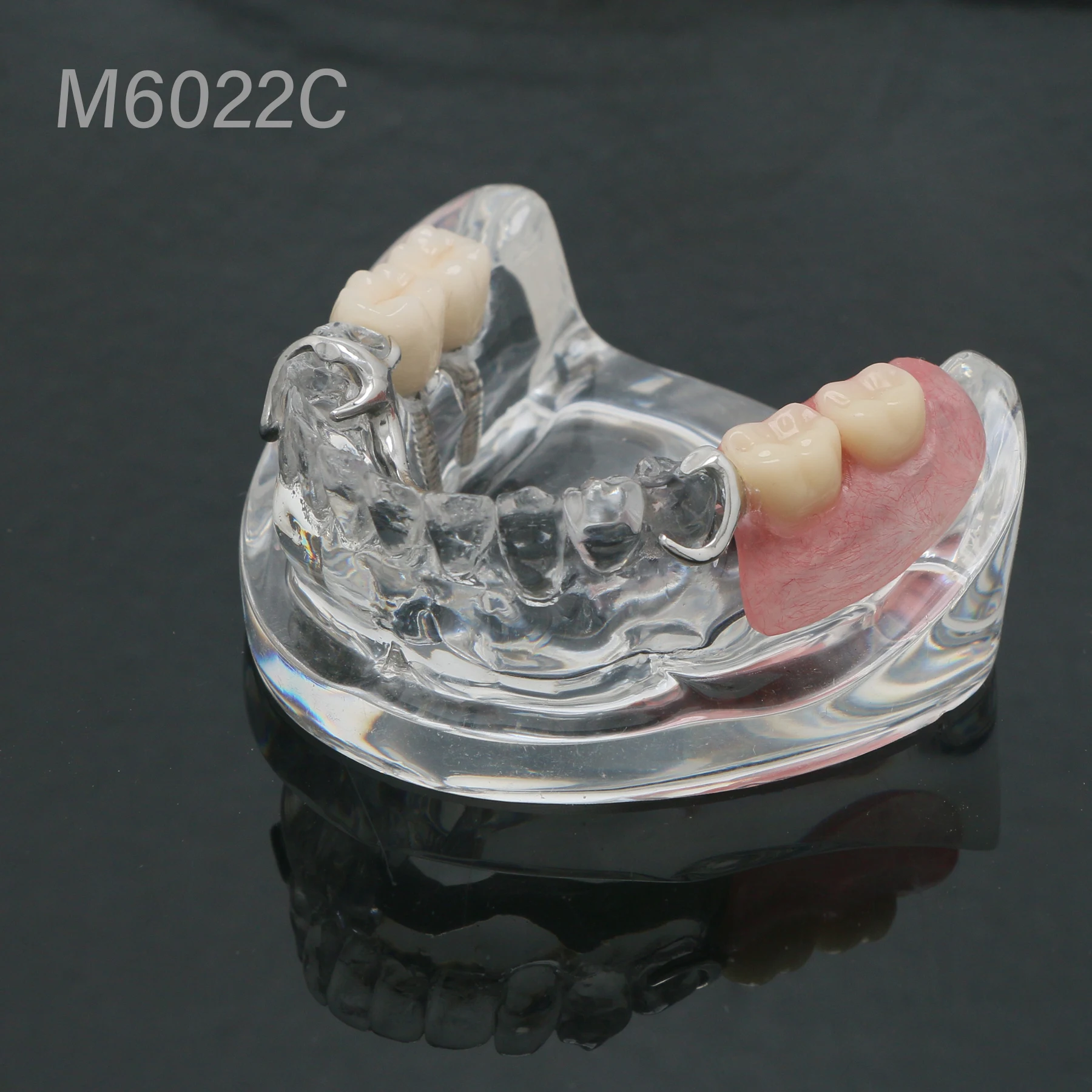 2 Implants Implant Restoration Teeth Model with Partial Denture M6022C Partial Denture Demo