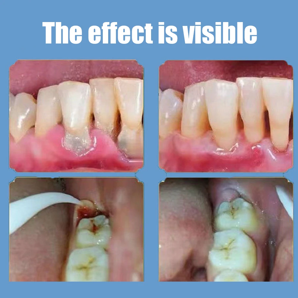 Pasta de dientes para reparación de cavidades y Caries, eliminación de manchas de placa, decaimiento, blanqueamiento, coloración amarilla,