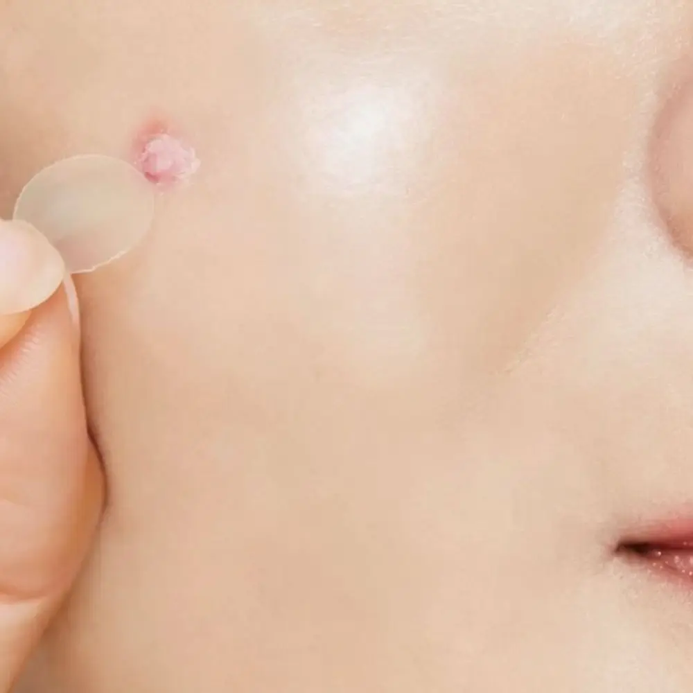 Acne Patch Kit With Cleansing Swabs Facial Skin Care Treatment Tool Invisible Blemish Cover Sticker For Face Cleansing