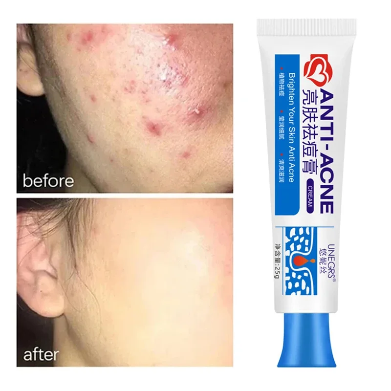 

Salicylic Acid Acne Treatment Cream Repair Pimple Spots Shrinking Anti-acne Deep Cleaning Pore Oil Control Moisturizer Skin 2024