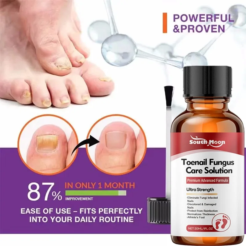 Sérum de traitement fongique des ongles, élimination des champignons, traitement du Paronychia, liquide Anti-gris, Infection des orteils, réparation des pieds, outils de soins
