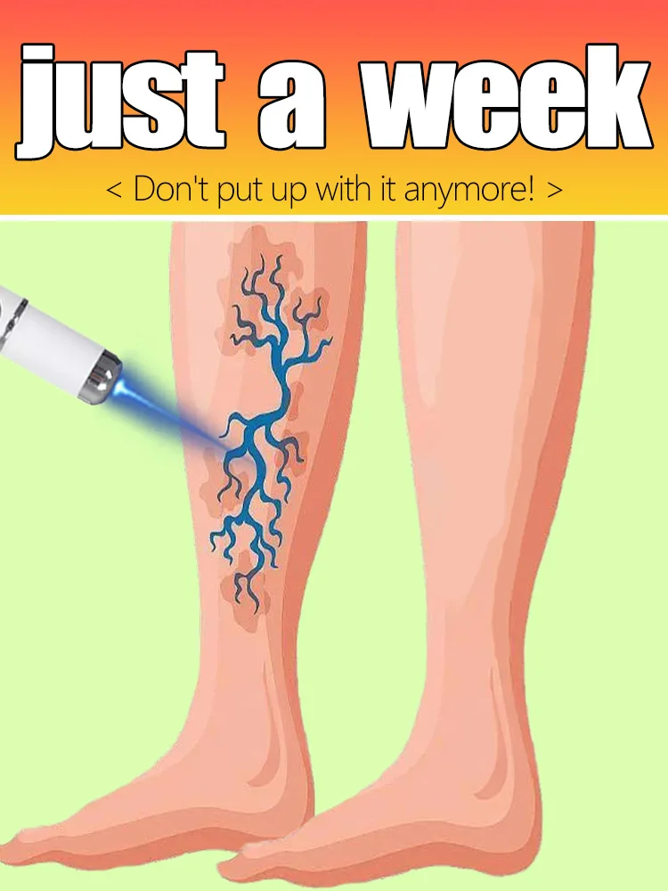 Leg care tool blue laser eliminates varicose veins painlessly