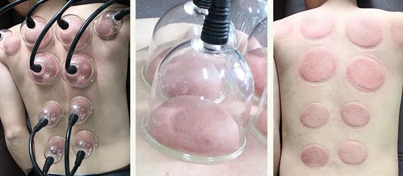 FARSLIM 2023 Vacuum Breast Enhancement Machine Butt Lifting Hip Lift Breast Massage Body cupping big cups for home use