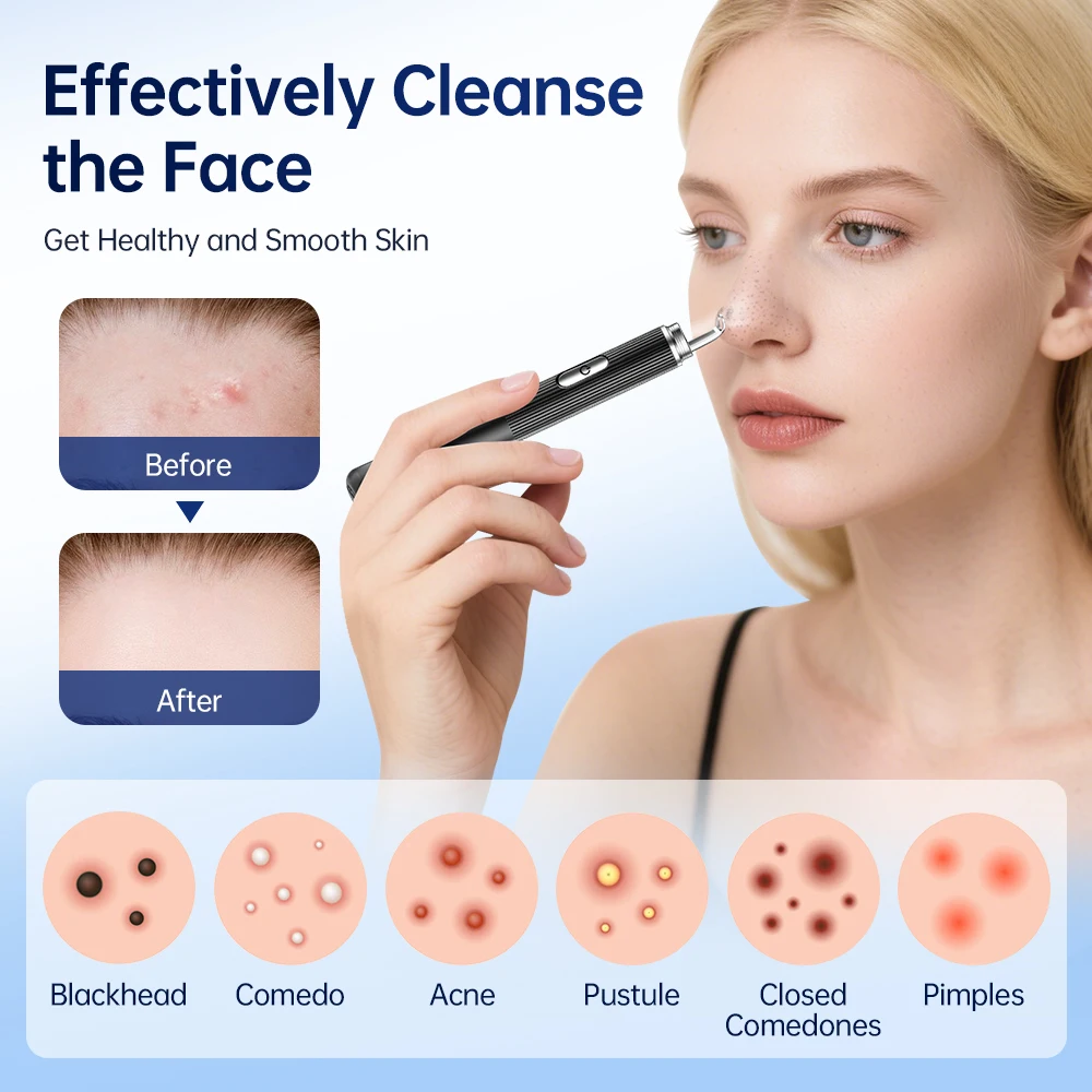 Visuele mee-eter verwijderaar met camera voor poriereiniger Puistje Comedo Acne Whitehead Extractor met roestvrijstalen kit