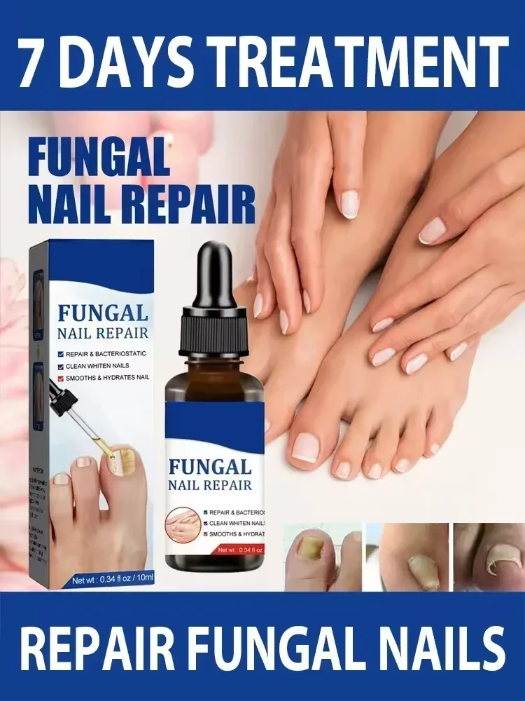 Effective Fungal Nail Treatments Nail Repair Oil Toe Repair Essence Powerful Anti Infection Cream for Fungal Nail Treatment