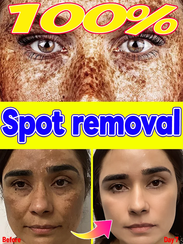 

The ultimate solution for freckles and pigmentation issues, 100% fading of hyperpigmented spots