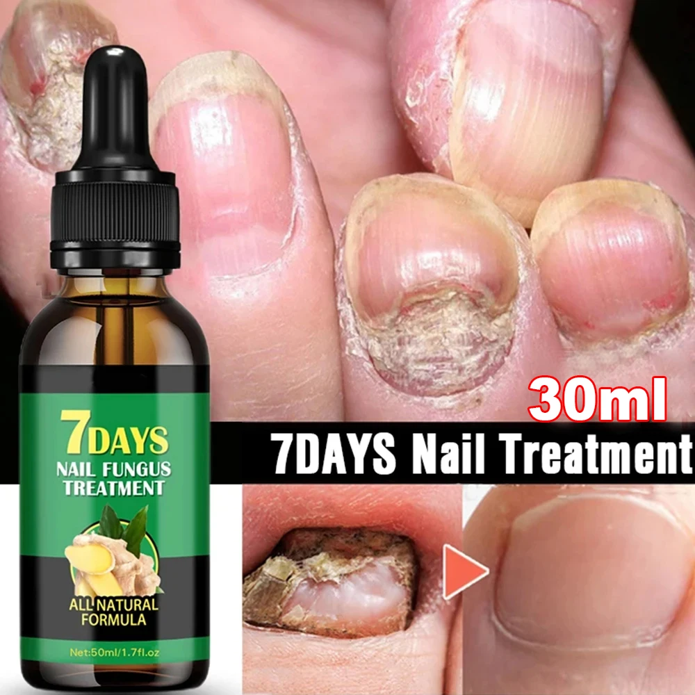 30ml Fungal Nail Treatment Essence Oil Nail Fungus Laser Device Repair Toenail Fingernail Treatment Onychomycosis with Mushrooms