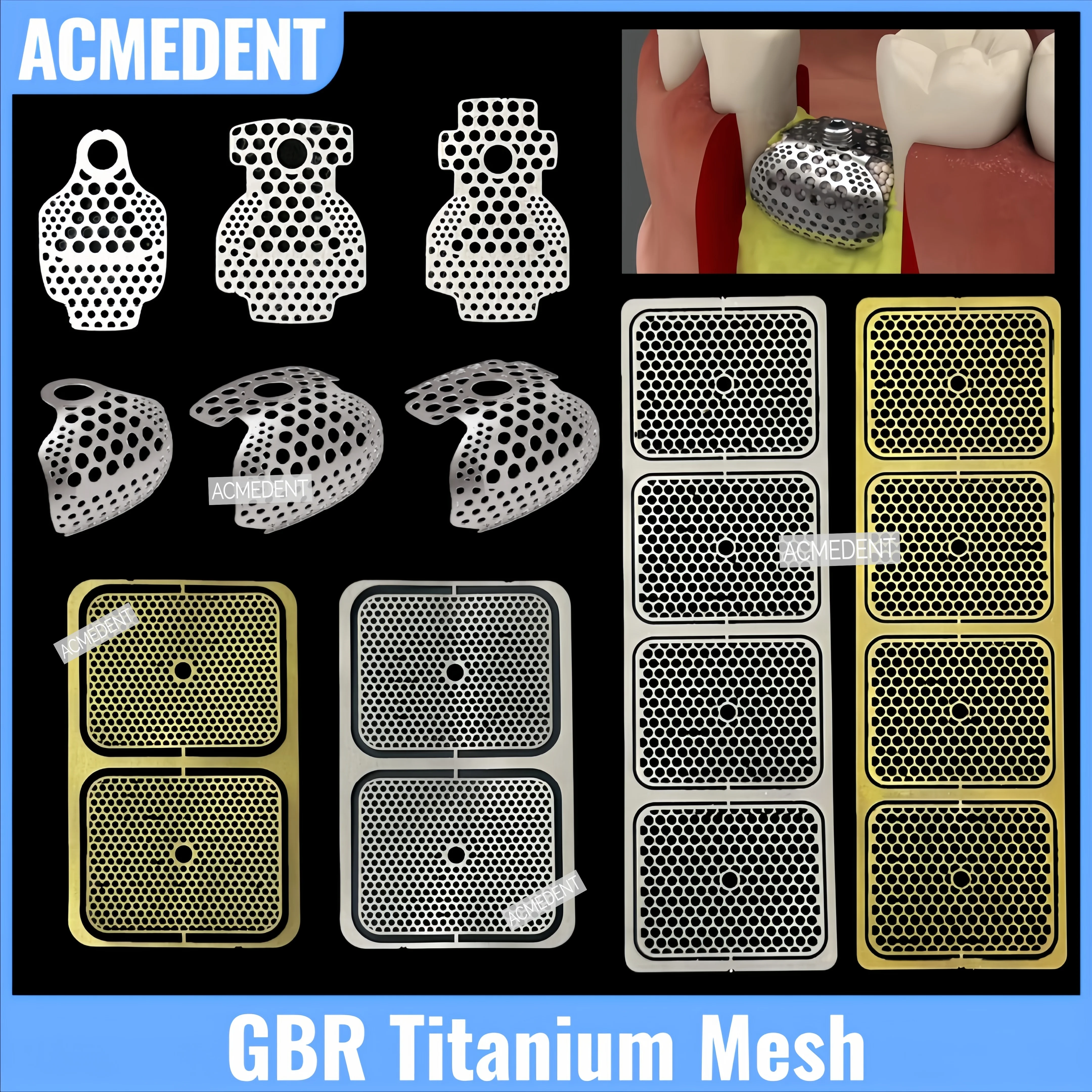 

Dental OB2 2/4-IN-1 GBR Titanium Mesh Guided Bone Regeneration Implant 1/2/3 Wall Augmentation Membrane Plate SmartBuilder