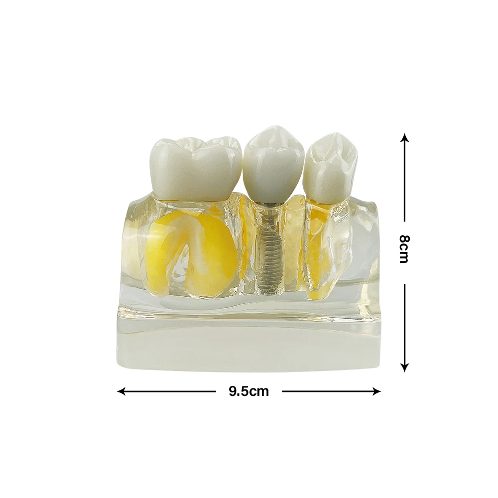 Dental Implant Model Dental Teaching Tools 4x Implant Explanation Split Model mplant Analysis Crown Bridge Removable Model