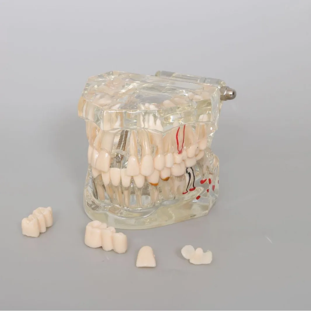 2pcs Dental Oral Transparent Restoration Dental Model Implant Nail Display Dental Model Pathology Display Teaching