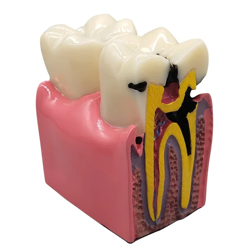 8 Times Dental Caries Model Disease Teeth Dental Model for Dental Demonstration Model Dentist Teaching Dental Lab Oral Research