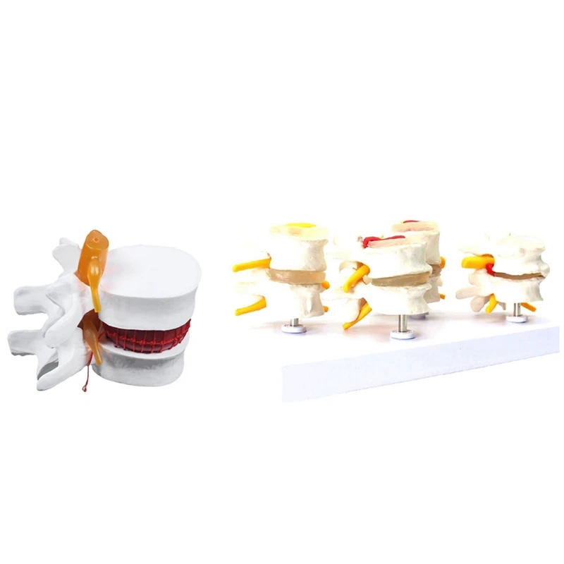 

2025 New 1 Pcs Skeleton Spine Lumbar Disc Herniation Teaching Model & 1 Pcs Human Anatomy Skeleton Spine Vertebral Model