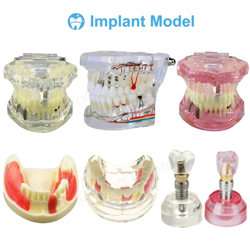 Imagen 2 del producto Implante de modelo de dientes dentales con modelo de educación Dental extraíble para laboratorio de odontología, herramienta de estudio de productos de odontología