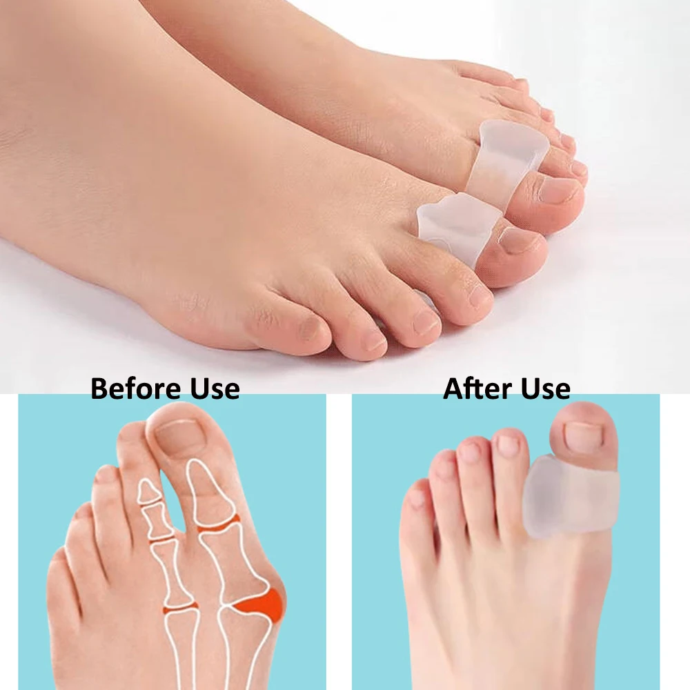 2Pcs Professional Orthopedic Corrective Insoles & Toe Separators for Relieve Overlapping Toes Soft Gel Toe Spacers for Men Women