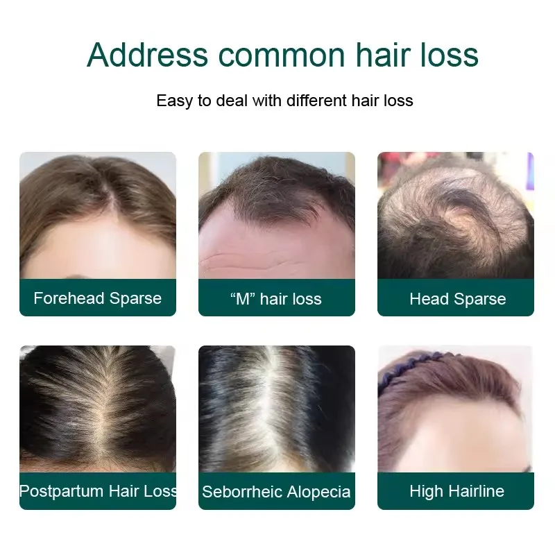 Óleo De Crescimento De Cabelo Para Homens E Mulheres, Tratamento De Perda De Cabelo, Soro De Óleo De Gengibre, Adultos