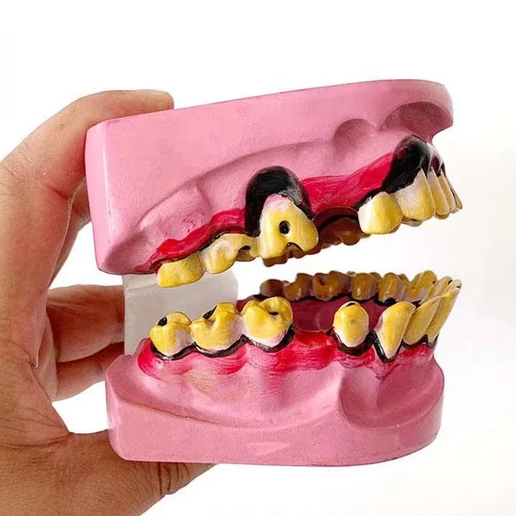 Teaching Resources Medical Education Oral Human Smokers Tooth Decay Smoking Pathological Tooth Model