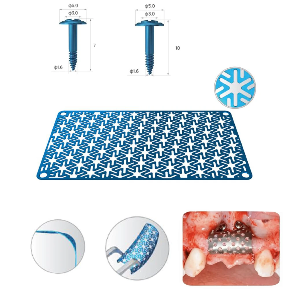 Dental GBR Bone Augmentation Titanium Mesh, Tent Screw Membrane Pin 3D Printed TA2G Pure Titanium Bone Graft Auxiliary Tool