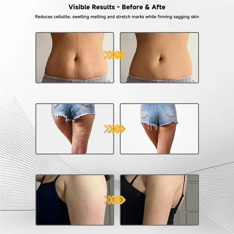 A01V-Massaggiatore per drenaggio linfatico e strumento per massaggio anticellulite, aiuta a ridurre le smagliature e la cellulite, per gambe, pancia