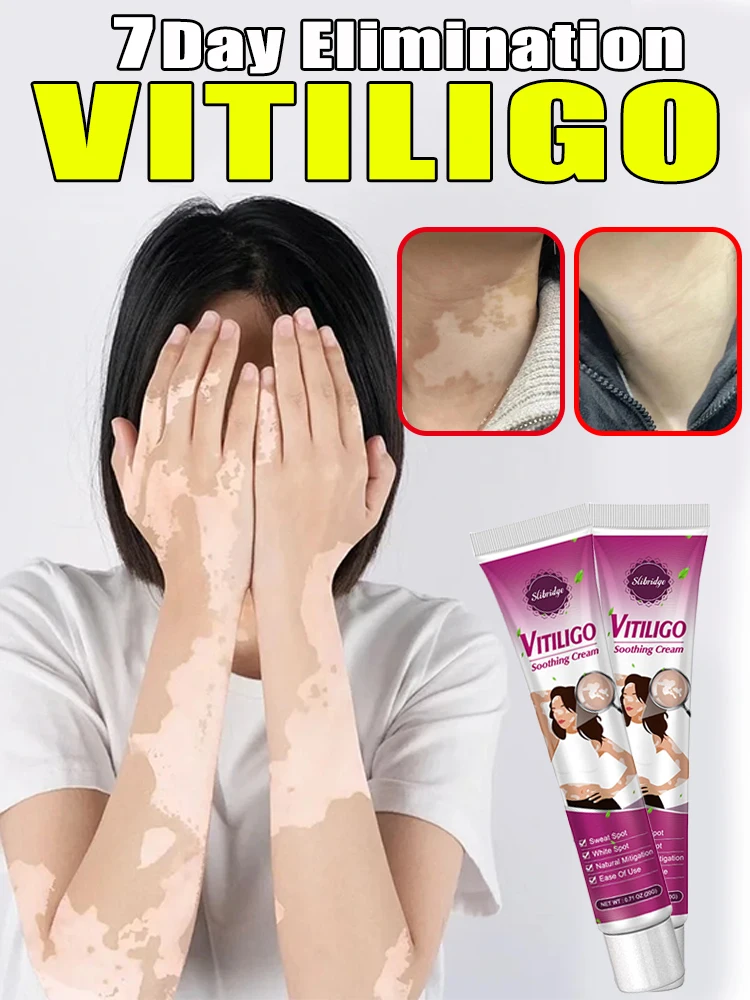 Vitiligo Behandlungs creme Melanin Wachstums salbe entfernen schnell weißen Fleck